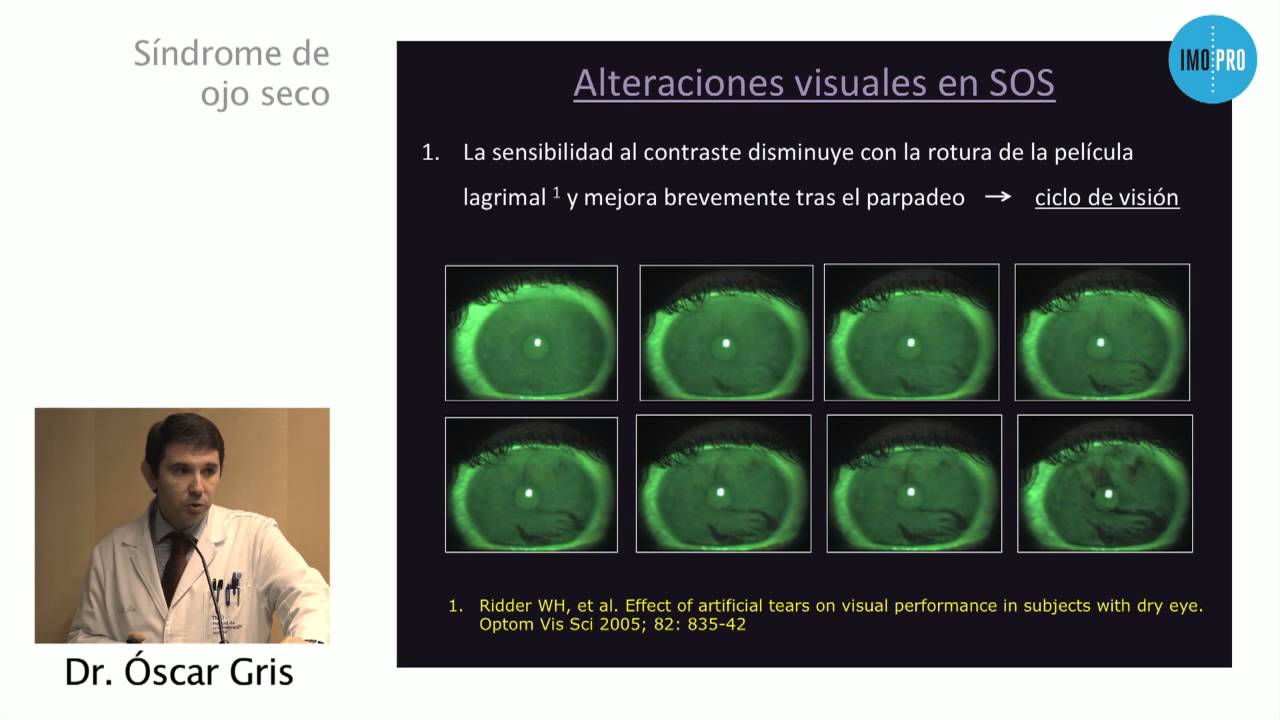Síndrome del ojo seco, la patología oftalmológica más frecuente (Dr. Óscar Gris)