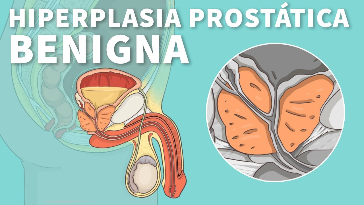 Hiperplasia prost&aacute;tica benigna: Causas, s&iacute;ntomas y tratamiento (HPB) | Stanford
