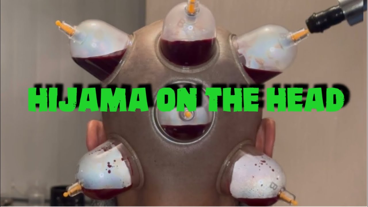 Benefits of getting Hijama on the Head || Wet cupping