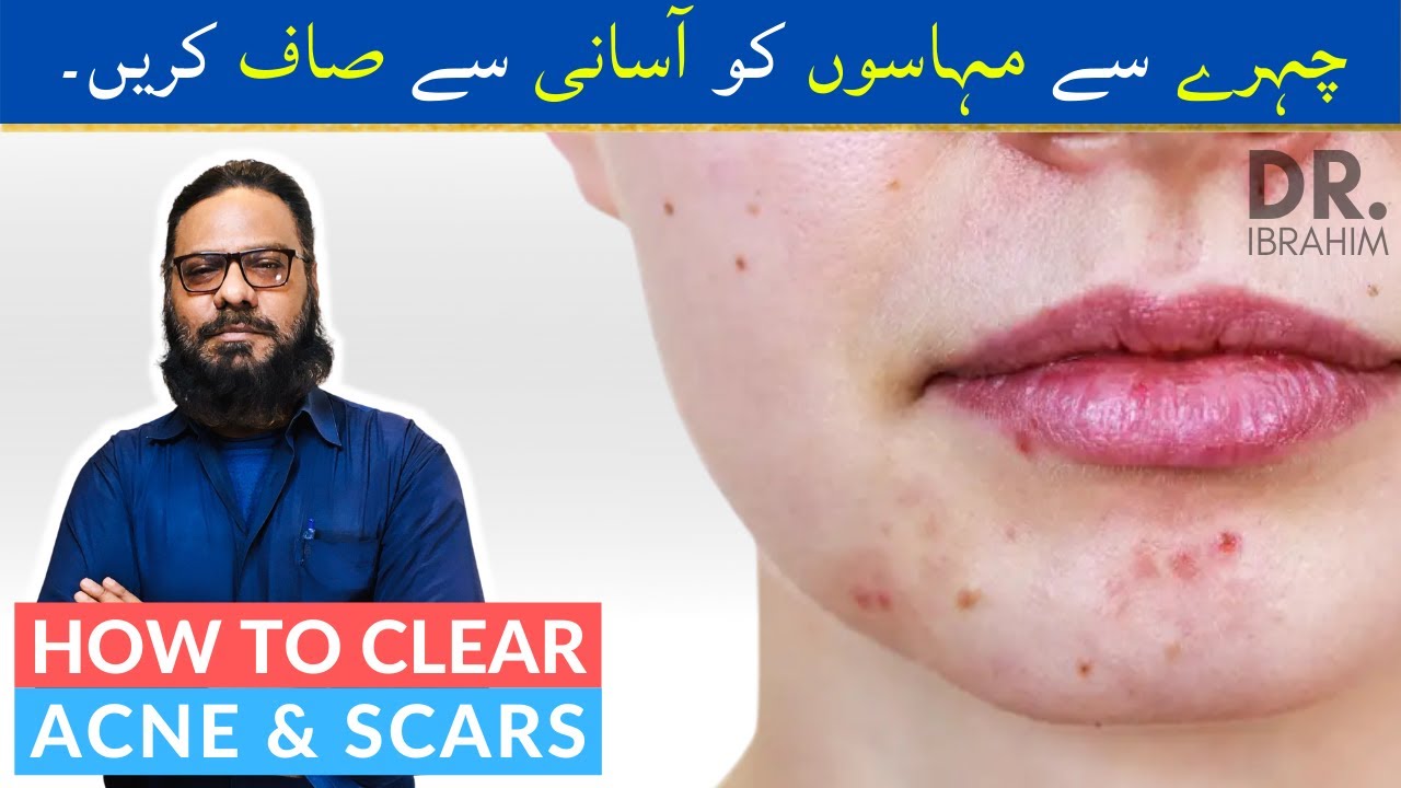 Muhase/Acne Ka Ilaj | How To Clear Your Face From Acne/Zits/Pimple/Blemishes in Urdu, Hindi