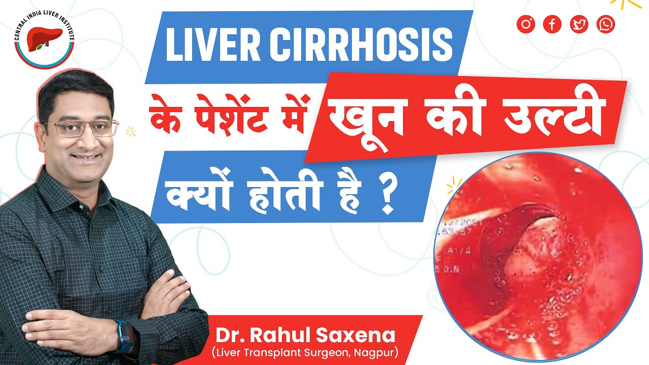 Why Does A Liver Cirrhosis Patient Vomit Blood ? | Dr. Rahul Saxena | #liverhealth #livercirrhosis