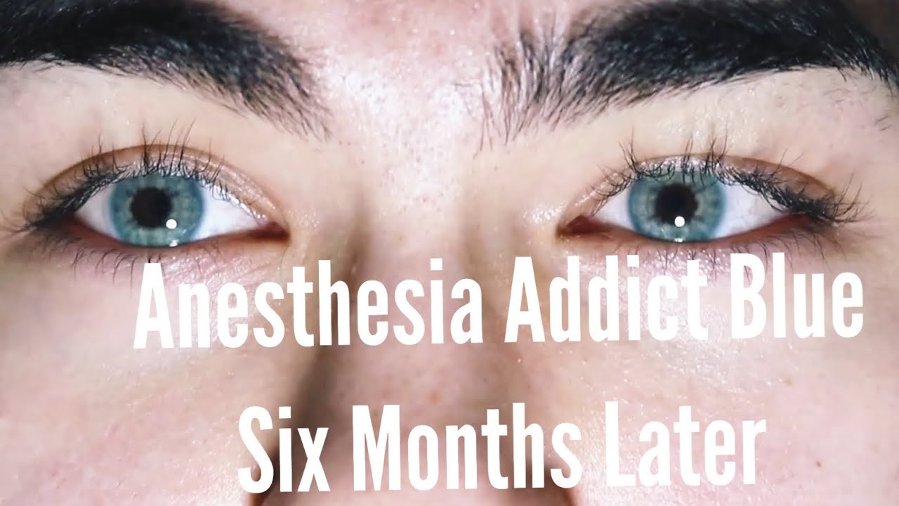 Anesthesia Addict Blue Contact Lenses | 6 Months Later