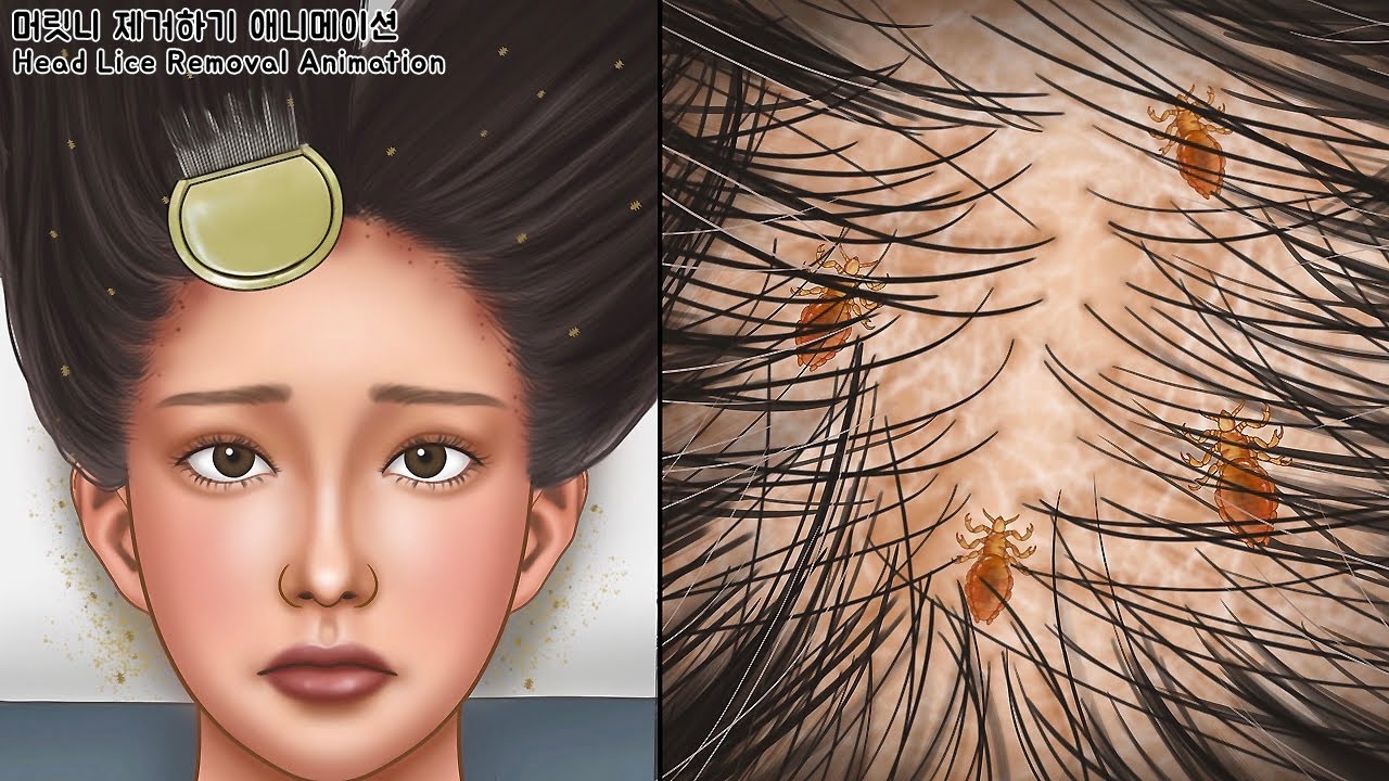 ASMR 소름주의! 근질근질 머릿니 속 시원하게 제거하기 | 지루성 피부염 치료 | Get rid of tons of head lice