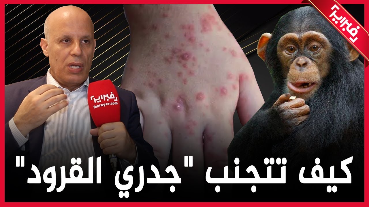 طبيب يشرح لكم أربعة قواعد لتجنب الاصابة بفيروس جدري القرود وحذاري من لمس القطط والحيوانات
