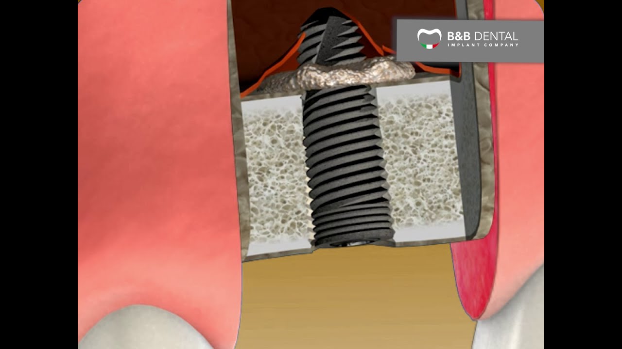 B&B Dental | transcrestal sinus lift protocol - sinus lift kit