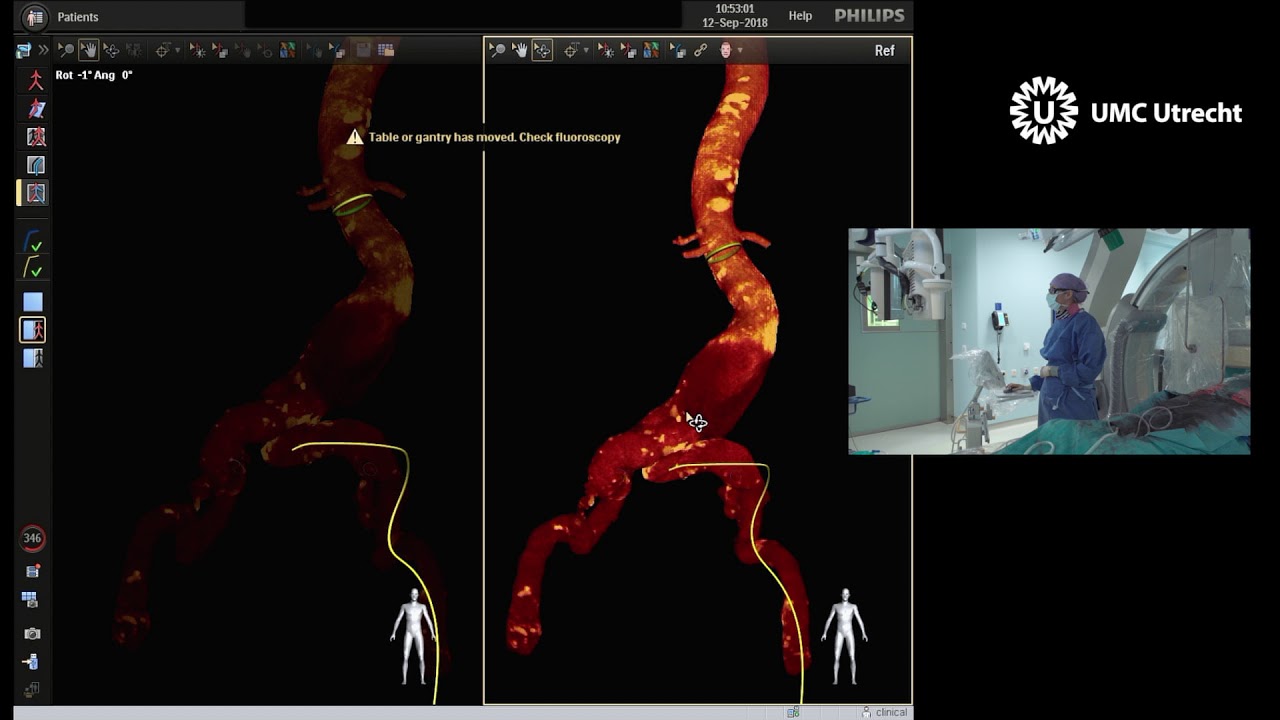 Fiber Optic RealShape (FORS) technology &ndash; FIH clinical Study