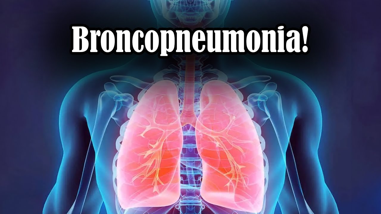 O que &eacute; Broncopneumonia?