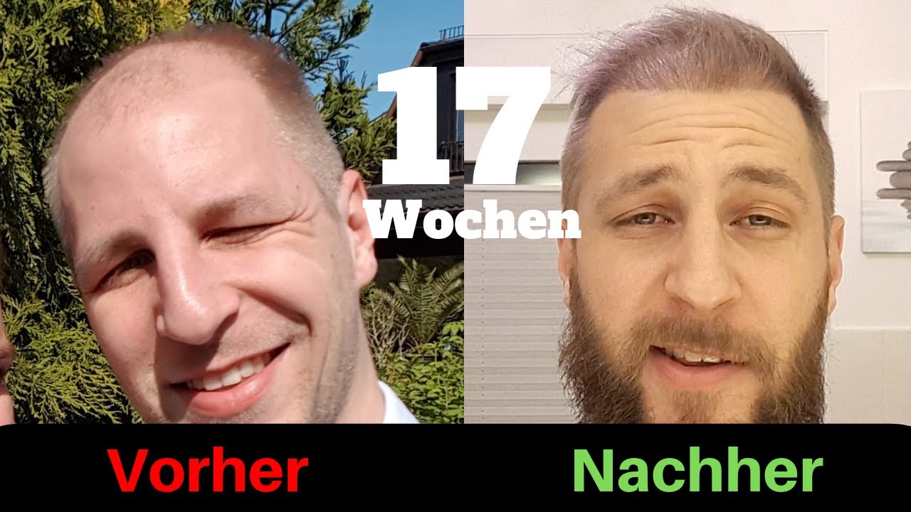 Haardichte 17 Wochen nach der zweiten Haartransplantation Türkei