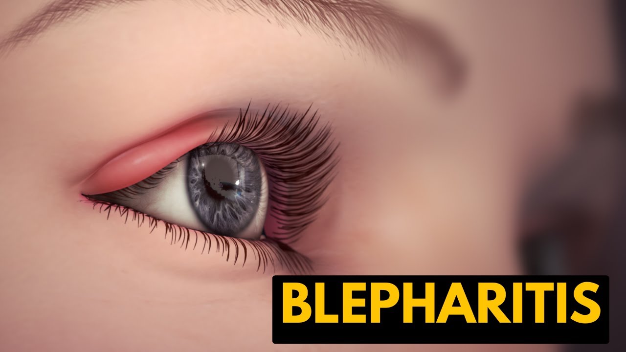 Blepharitis, Causes, Signs and Symptoms, Diagnosis and Treatment.