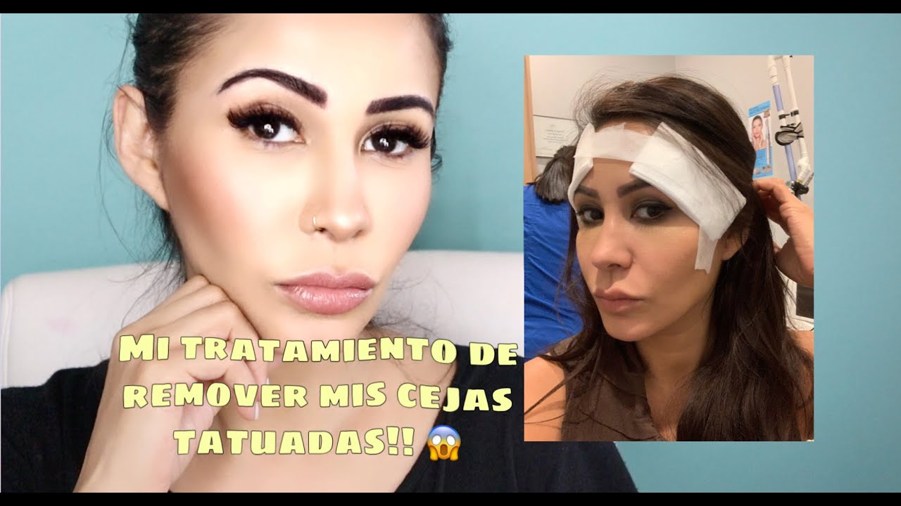 MI EXPERIENCIA CON EL LASER PARA REMOVER MIS CEJAS TATUADAS!!