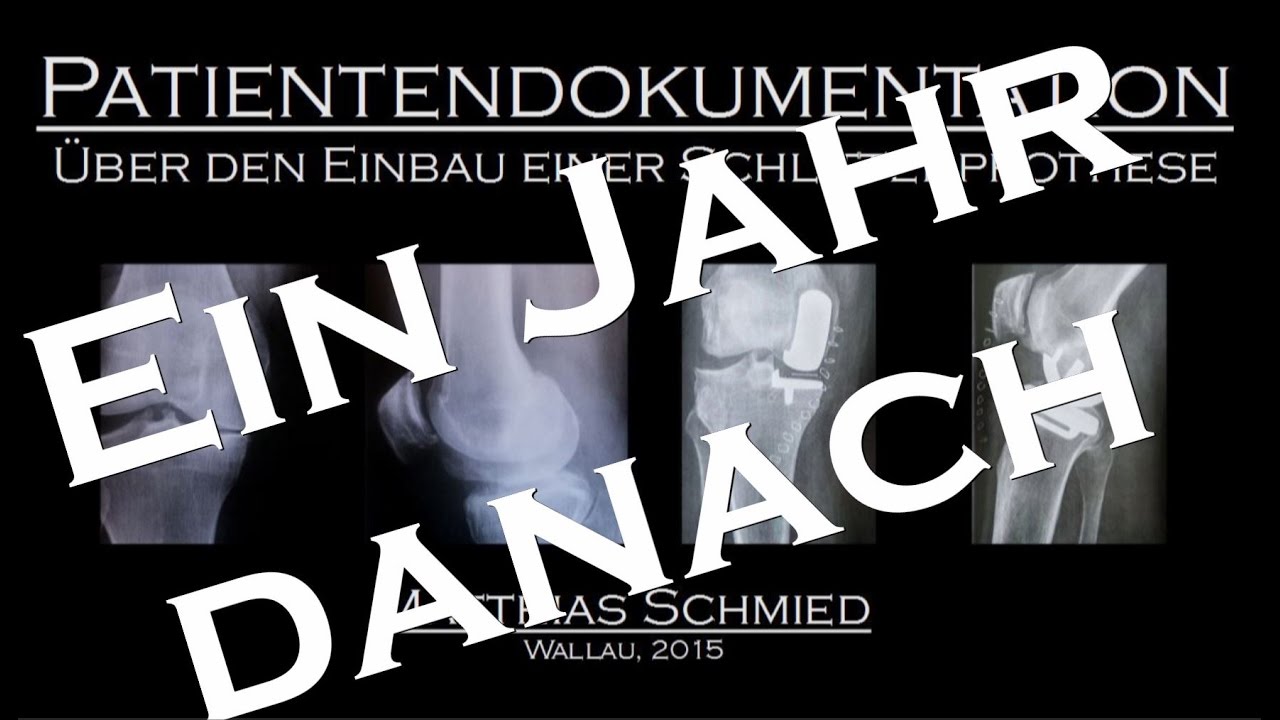 Patientendokumentation - Ein Jahr nach Einbau einer Schlittenprothese