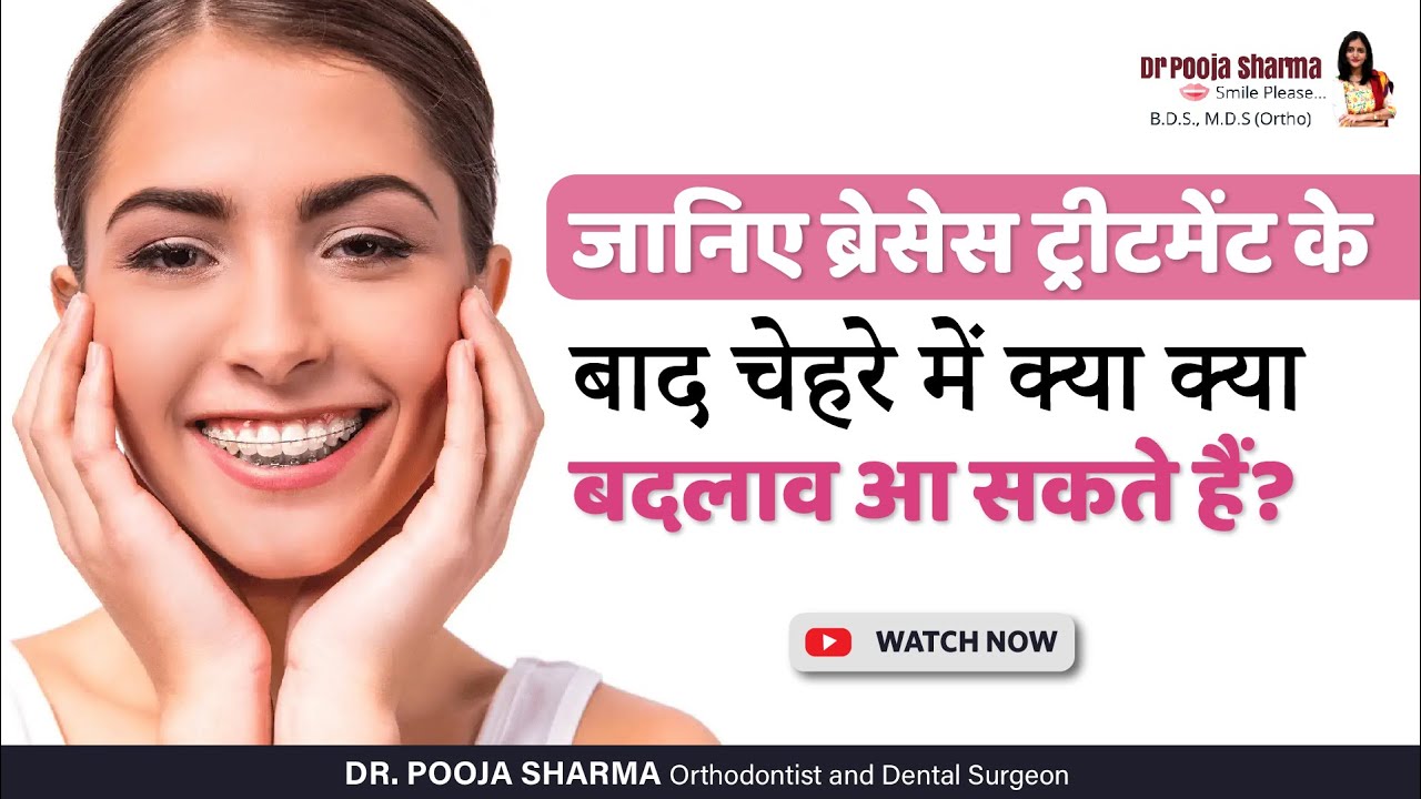 जानिए ब्रेसेस ट्रीटमेंट के बाद चेहरे में क्या क्या बदलाव आ सकते हैं?  Dr Pooja Sharma In Agra, UP