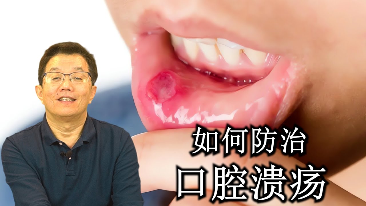 如何预防和治疗口腔溃疡