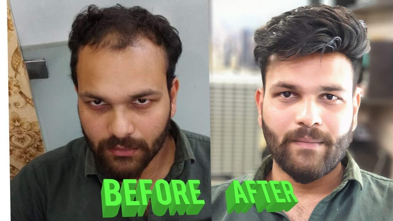 BEFORE & AFTER a non surgical hair transplant by master RIZY 8929576395, 88852017181, 9582581323