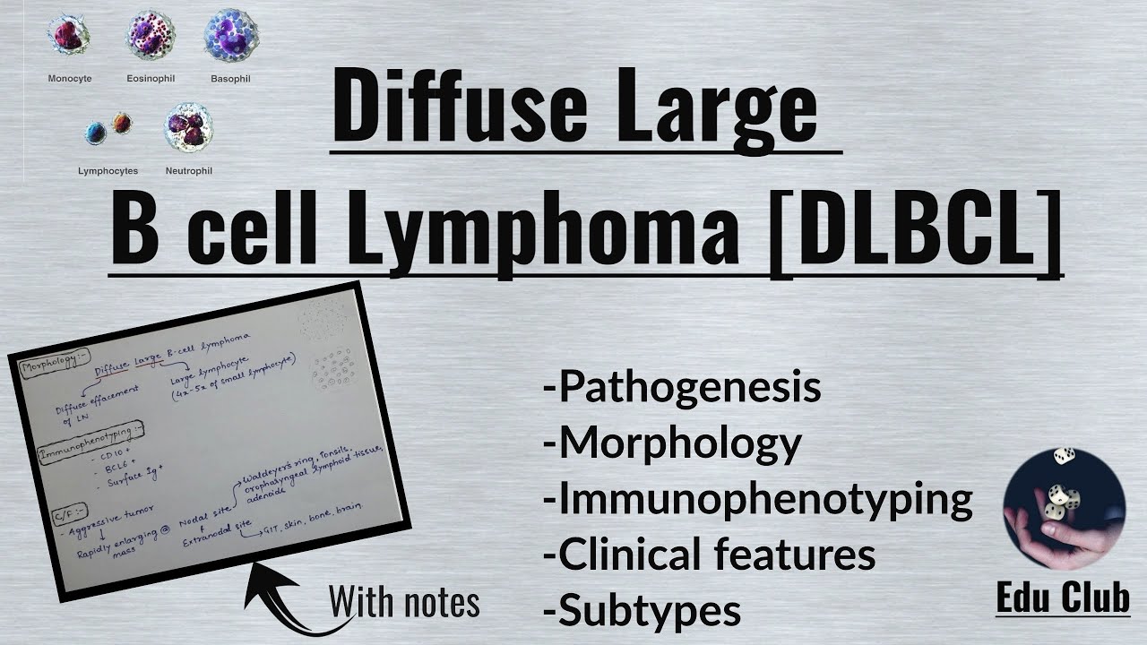Diffuse Large B cell Lymphoma | DLBCL | Non Hodgkin's Lymphoma || Pathology