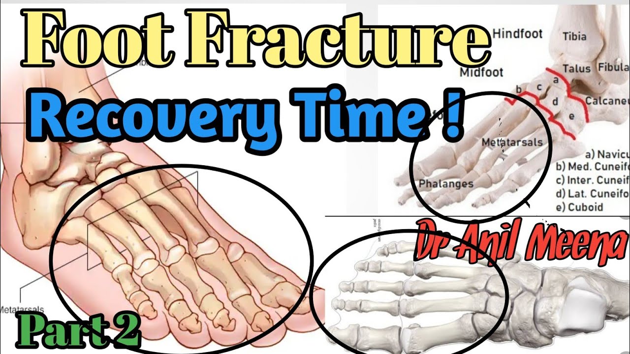 foot fracture recovery time | foot fracture treatment | metatarsal fracture recovery time |in hindi