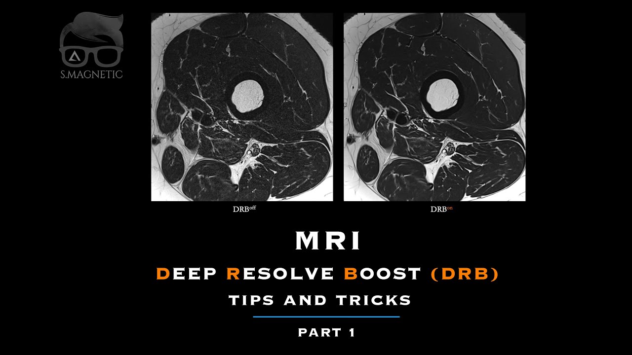 MRI DEEP RESOLVE BOOST (DRB) – TIPS & TRICKS