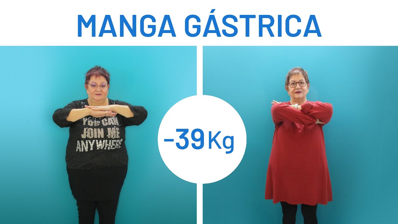 Adelgazar con Manga Gástrica [Antes y Después] - Clínicas Diego de León