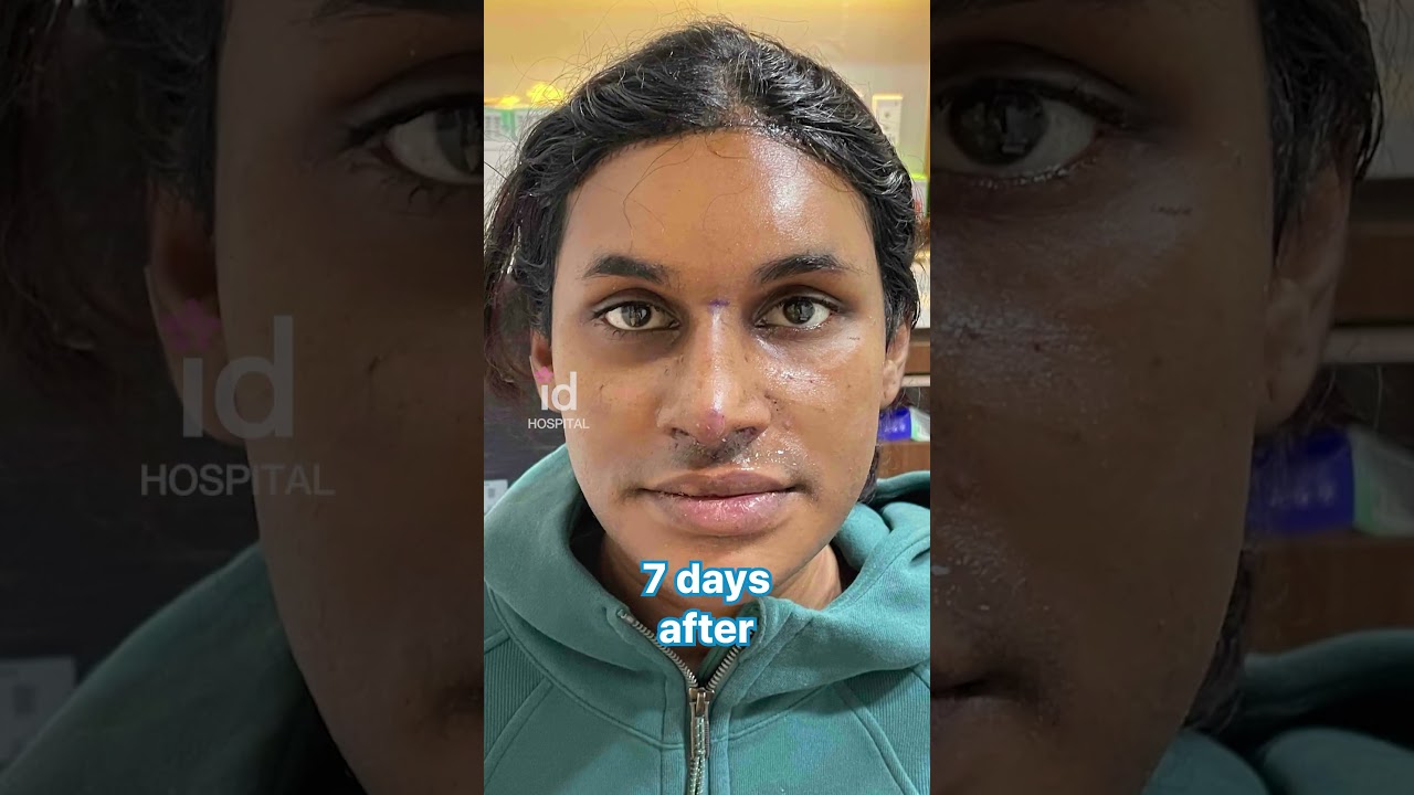 ID Hospital Facial Feminization Surgery: Her Complete Transformation Journey