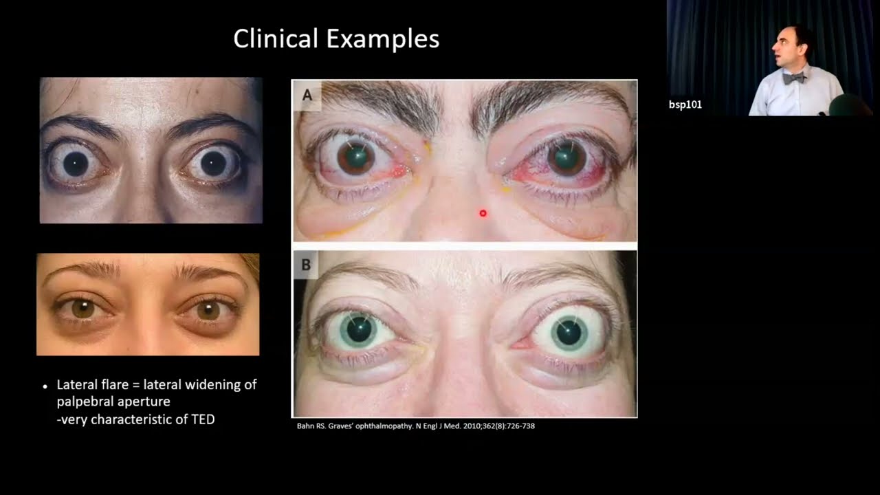 Thyroid Eye Disease: From the Ophthalmologist’s Perspective