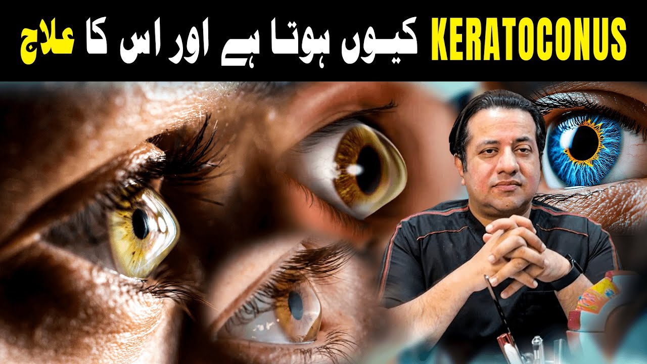 What is Keratoconus? Causes, Symptoms & Latest Treatment Options