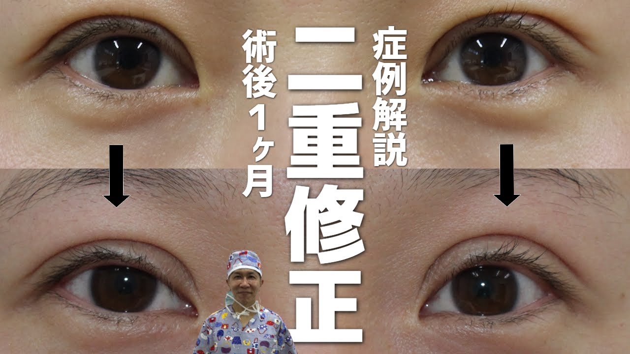 【二重修正の症例】幅狭く。術後１ヶ月。吊り上げと腱膜固定。濃い顔からの脱却を目指す