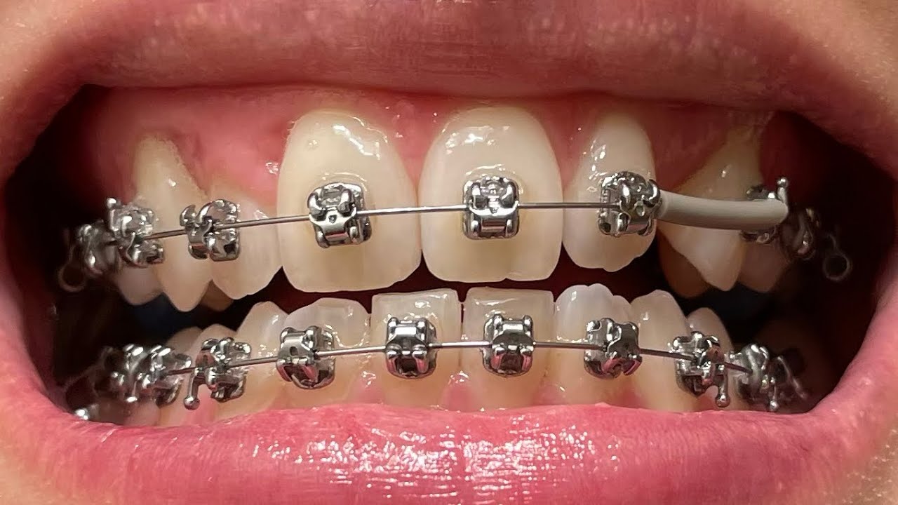Adult Braces - 16 Month Update