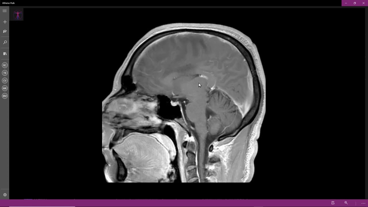Glioblastoma