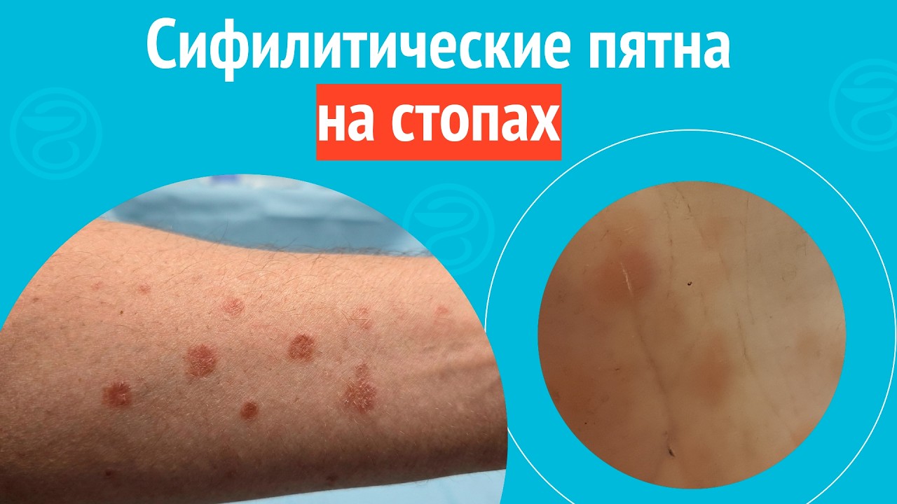 🦶 Сифилитические пятна на стопах. Клинический случай № 1727
