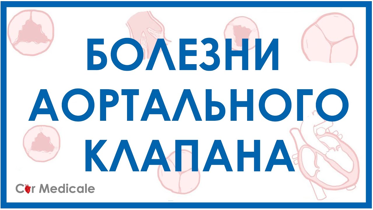 Болезни аортального клапана: аортальный стеноз, недостаточность аортального клапана.