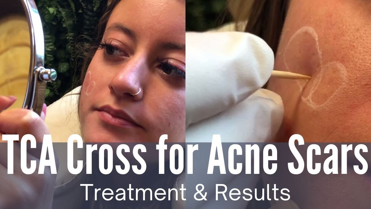 #TCA Cross: The Best Treatment for Ice Pick Acne Scars | Full Treatment & Before and After Photos