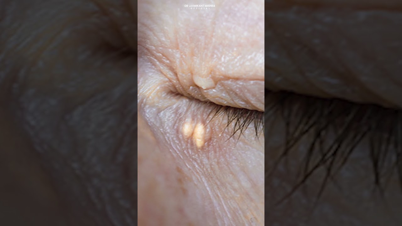 White Patches Near Eyes? Xanthelasma Explained &ndash; Causes & Best Treatments!