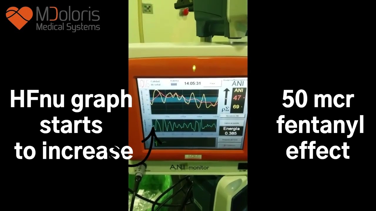ANI detects nociception and shows the effect of fentanyl bolus
