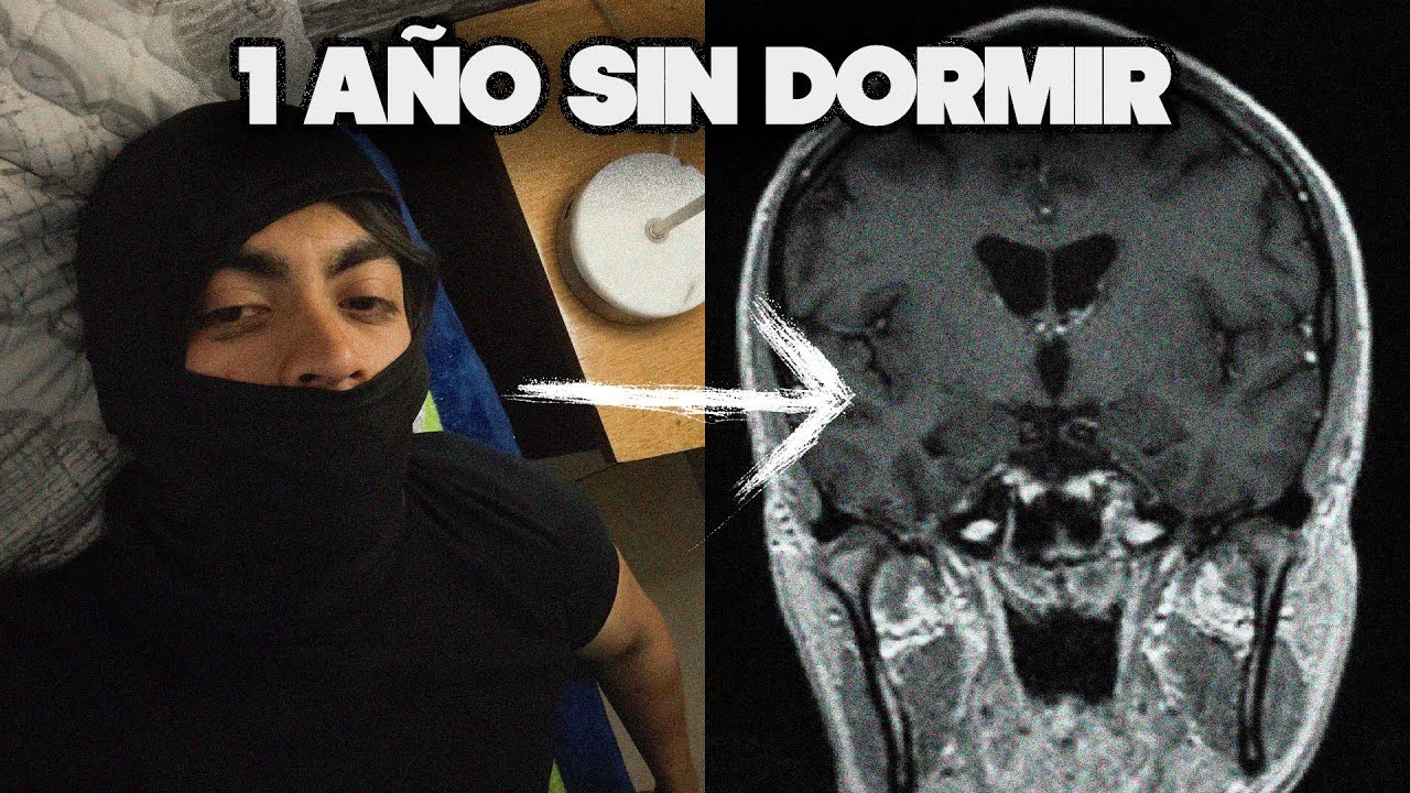 ‘’TENGO PESADILLAS VIVIDAS’’ - INSOMNIO FATAL ESPORADICO (HISTORIA)