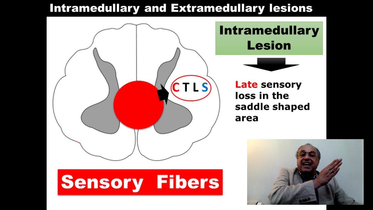 Difference Between Intramedullary and Extramedullary lesions (Neurology) #cme   #محاضرات_باطنة