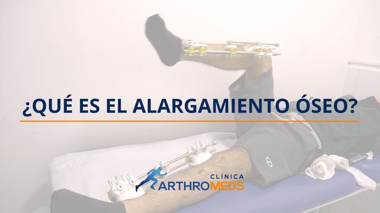 Alargamiento óseo: ¿En qué consiste?