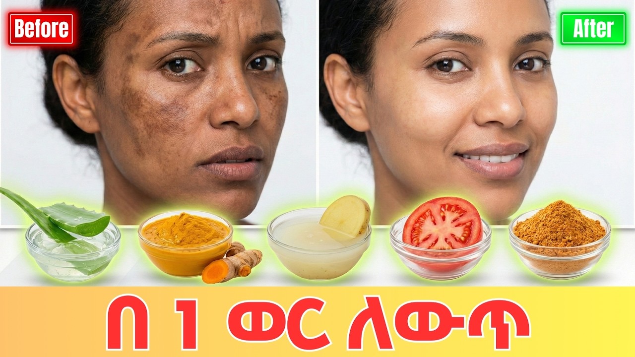 5ቱ የማድያት ተፈጥሯዊ መፍትሄዎች፡ የፊት ጥቁረትን በቤት ውስጥ ለማጥፋት (በሳይንስ የተረጋገጠ)
