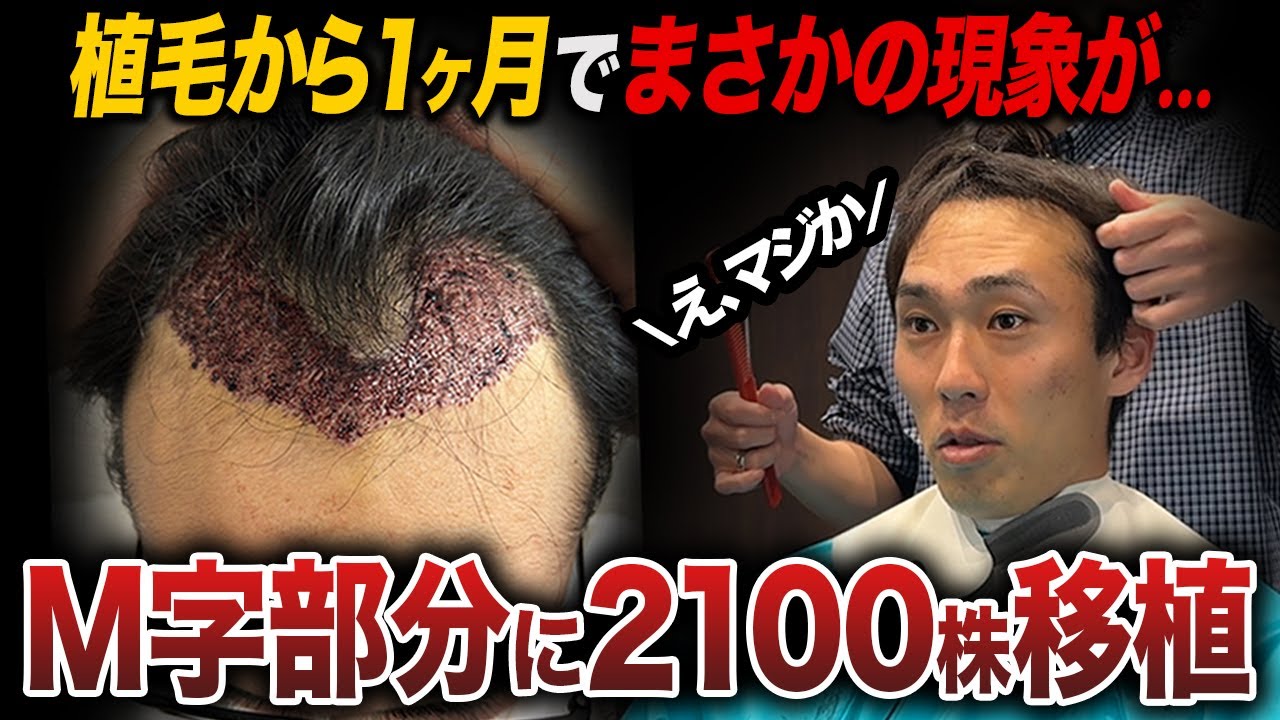 【予想外】植毛1ヶ月経過した状態がヤバくて出歩けない!?