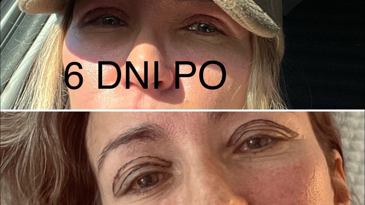 Blefaroplastyka - zrobilam powieki🇩🇰Czy bolalo? Zabieg, gojenie…