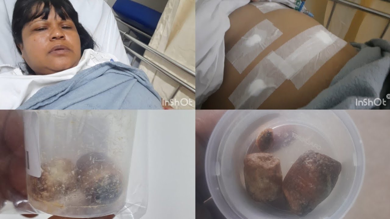 Cirurgia de vesícula por VÍDEO, pelo SUS no HMS SALVADOR BAHIA