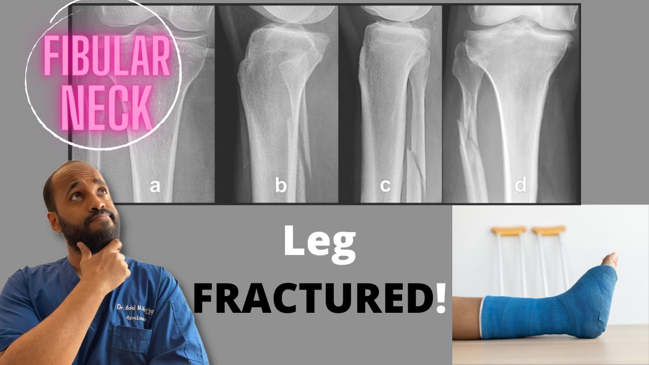 BROKEN Leg?. What if the Fibular Neck FRACTURED?!