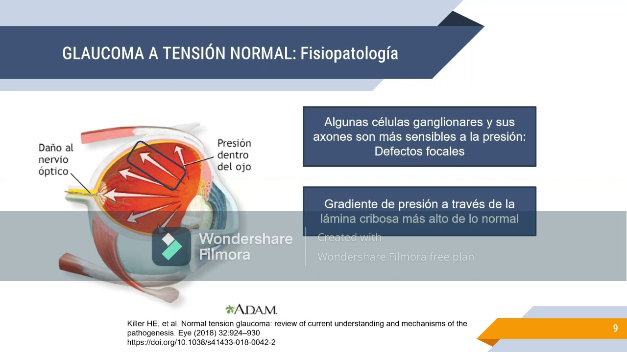 Glaucoma tensión normal  Dra C Maldonado