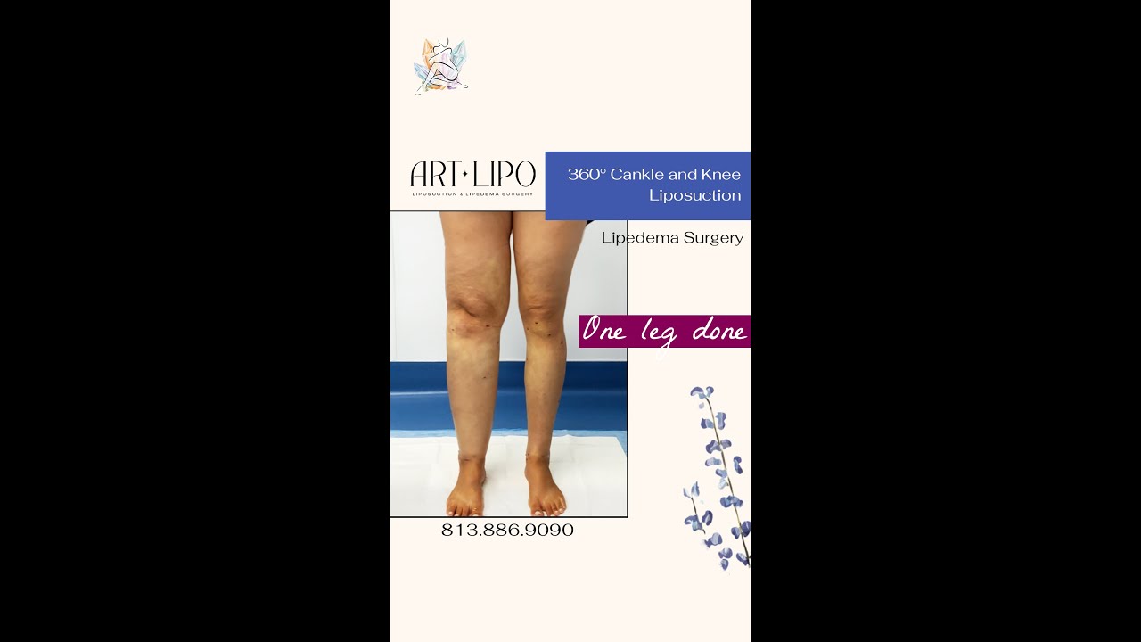 360&deg; Cankle and Knee #Lipedema Liposuction with Stunning Results 🤩