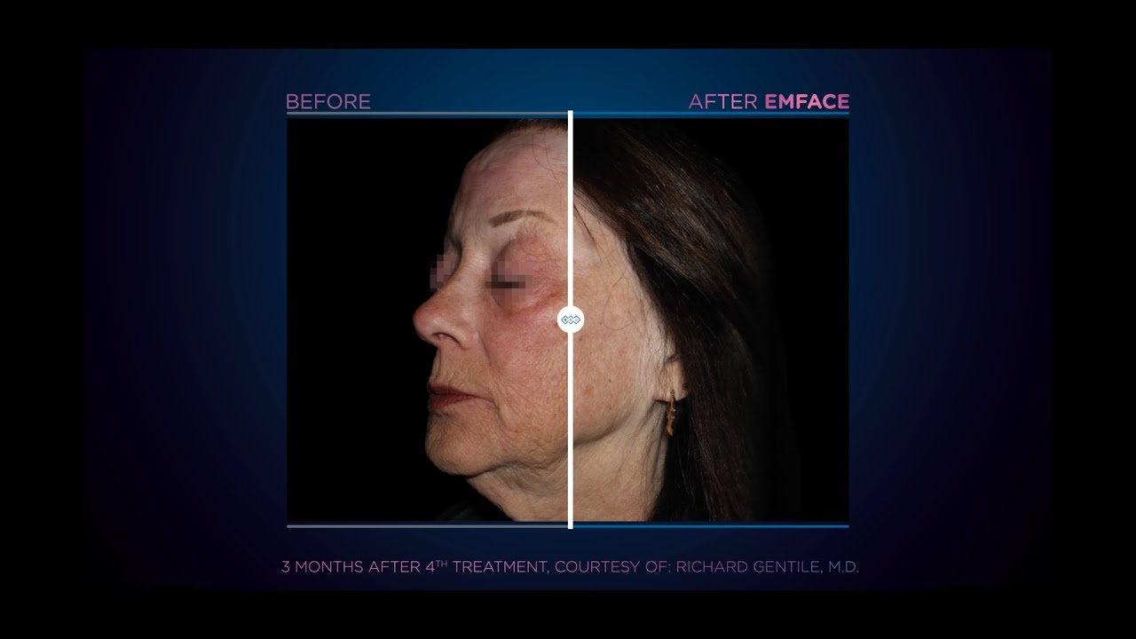 EMFACE Treatment Results