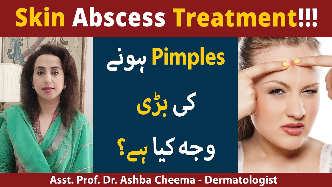 Skin Abscess: Causes, Symptoms & Treatment | Skin Acne Ka Ilaj | Bumps On Skin