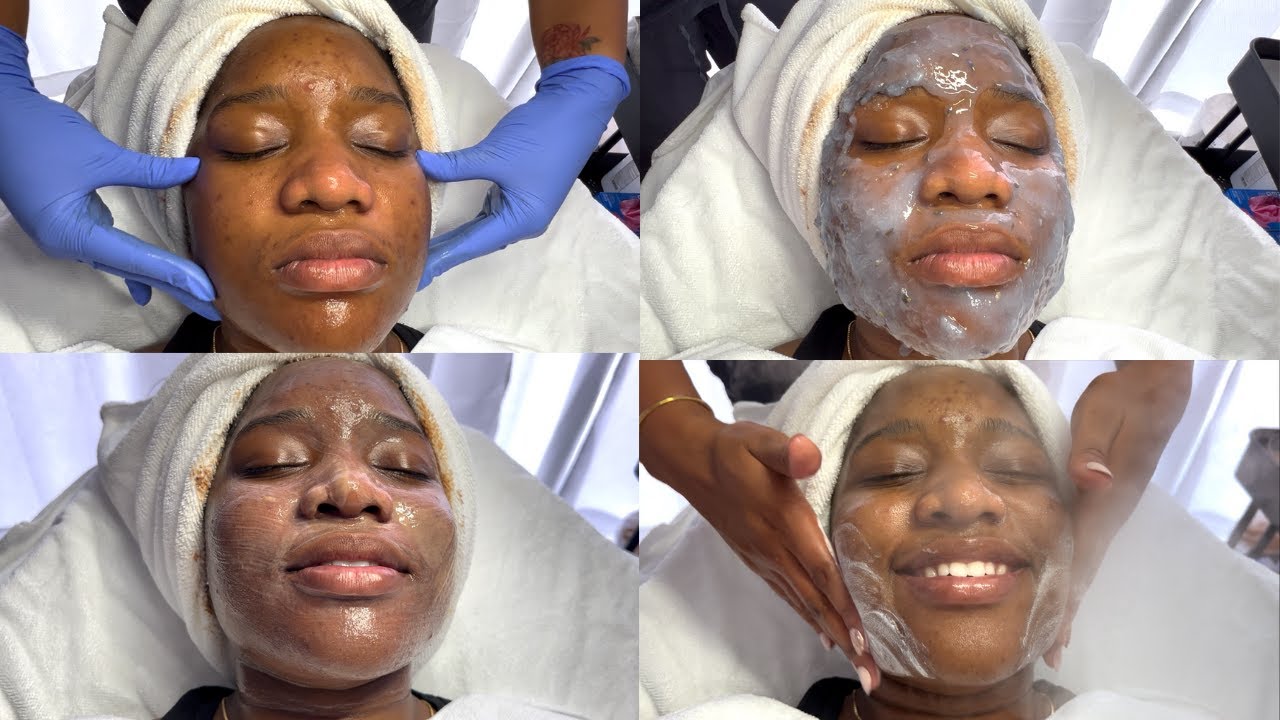 MICRODERMABRASION FOR ACNE SCARS