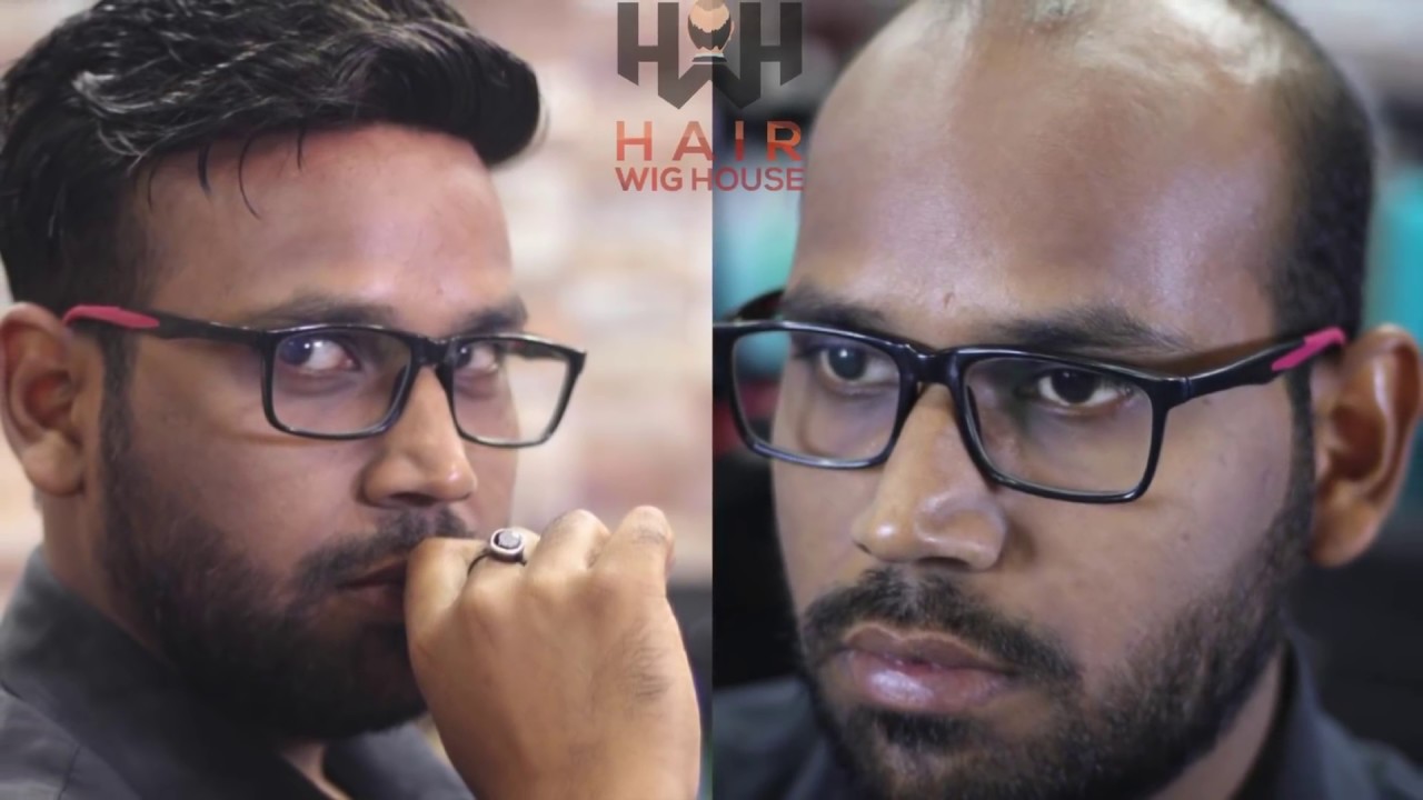 Natural Looking Hair Patch | BEST HAIR WEAVING In Delhi | Non surgical Hair Transplant  | 9953384242