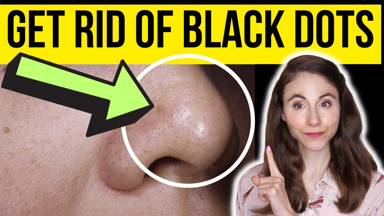HOW TO GET RID OF BLACK DOTS ON THE NOSE | Dermatologist