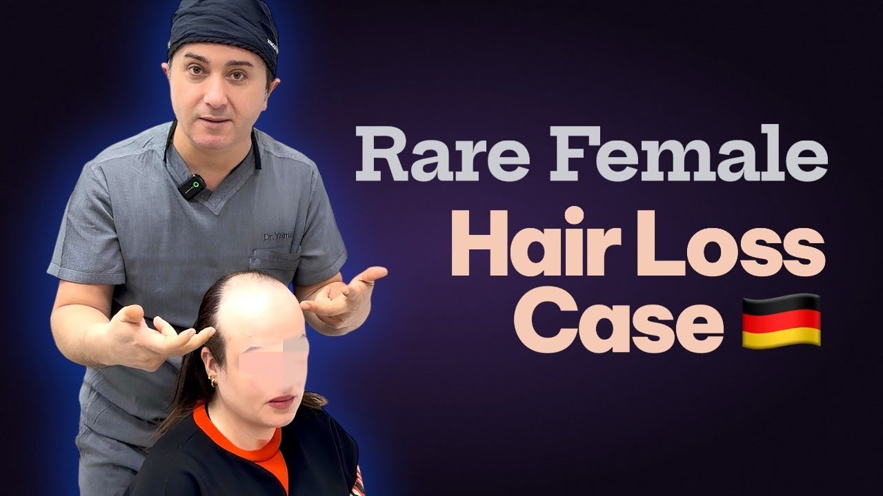 Uncommon Female Pattern Baldness Treated by Dr. Resul Yaman - Dr. Resul YAMAN