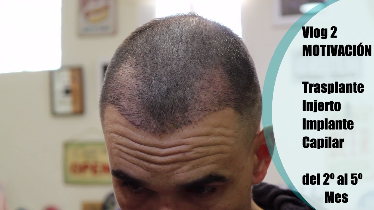 VLOG 2 TRASPLANTE DE PELO  2º al 5º MES